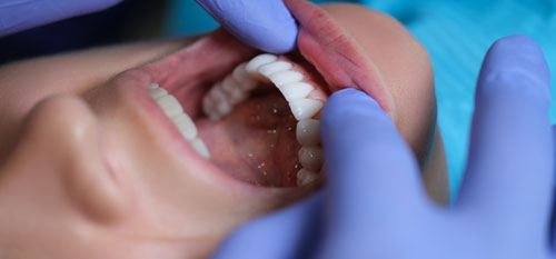 Porcelain-Veneers