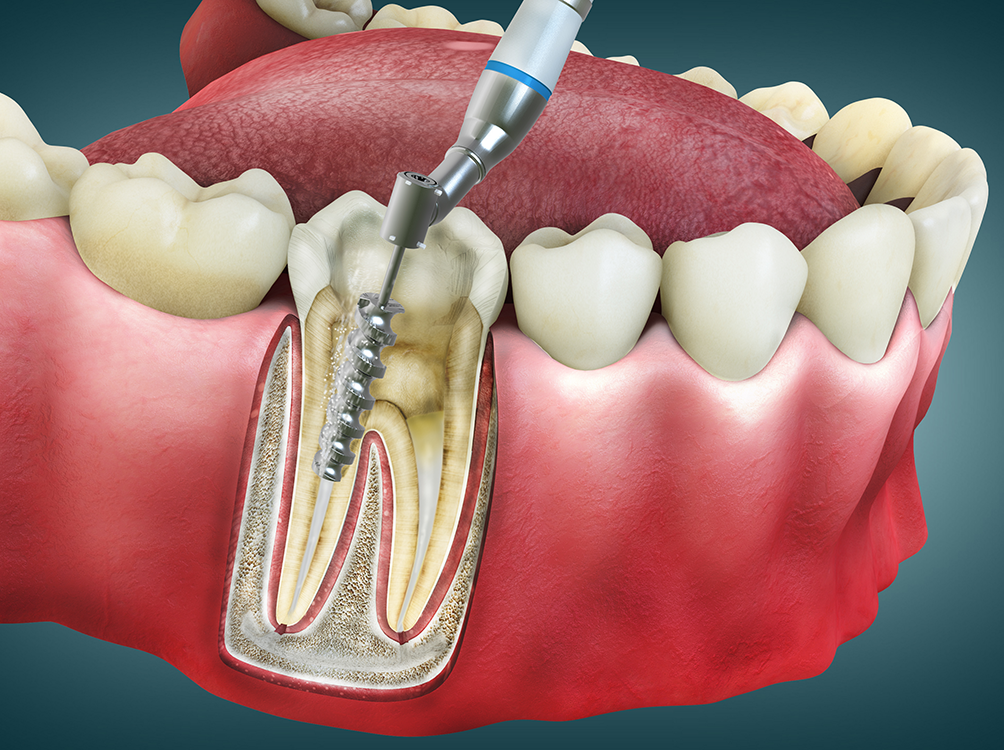 root-canal-1