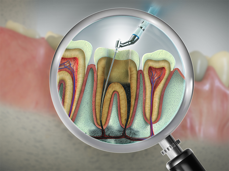 root-canal-2