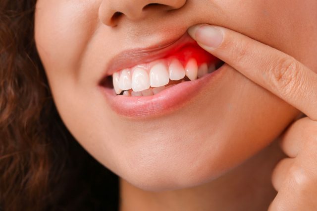 symptoms and treatment of gum diseases