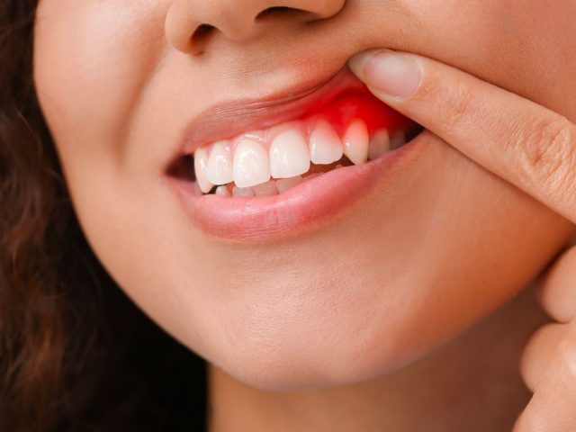 Symptoms and Treatment of Gum Diseases