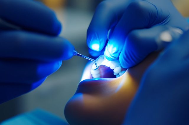 dental sealants what they are and how they work