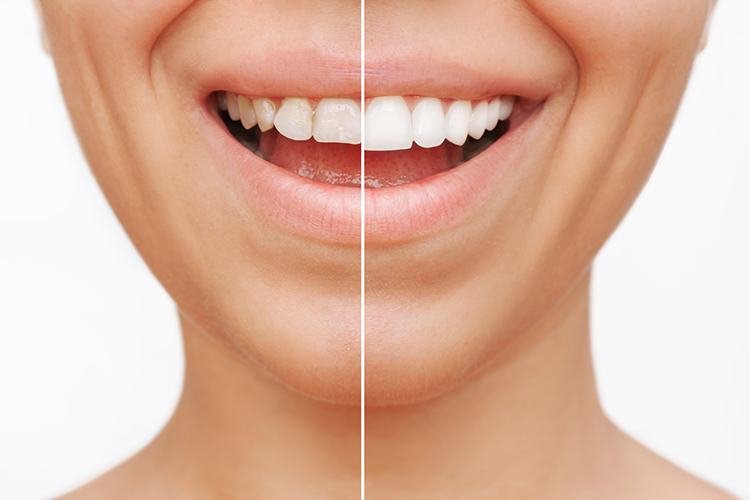 before-after-crown