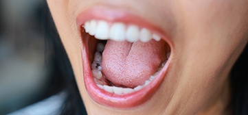 cavity-woman-mouth-open