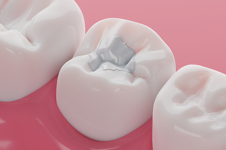 filling-on-tooth-graphic