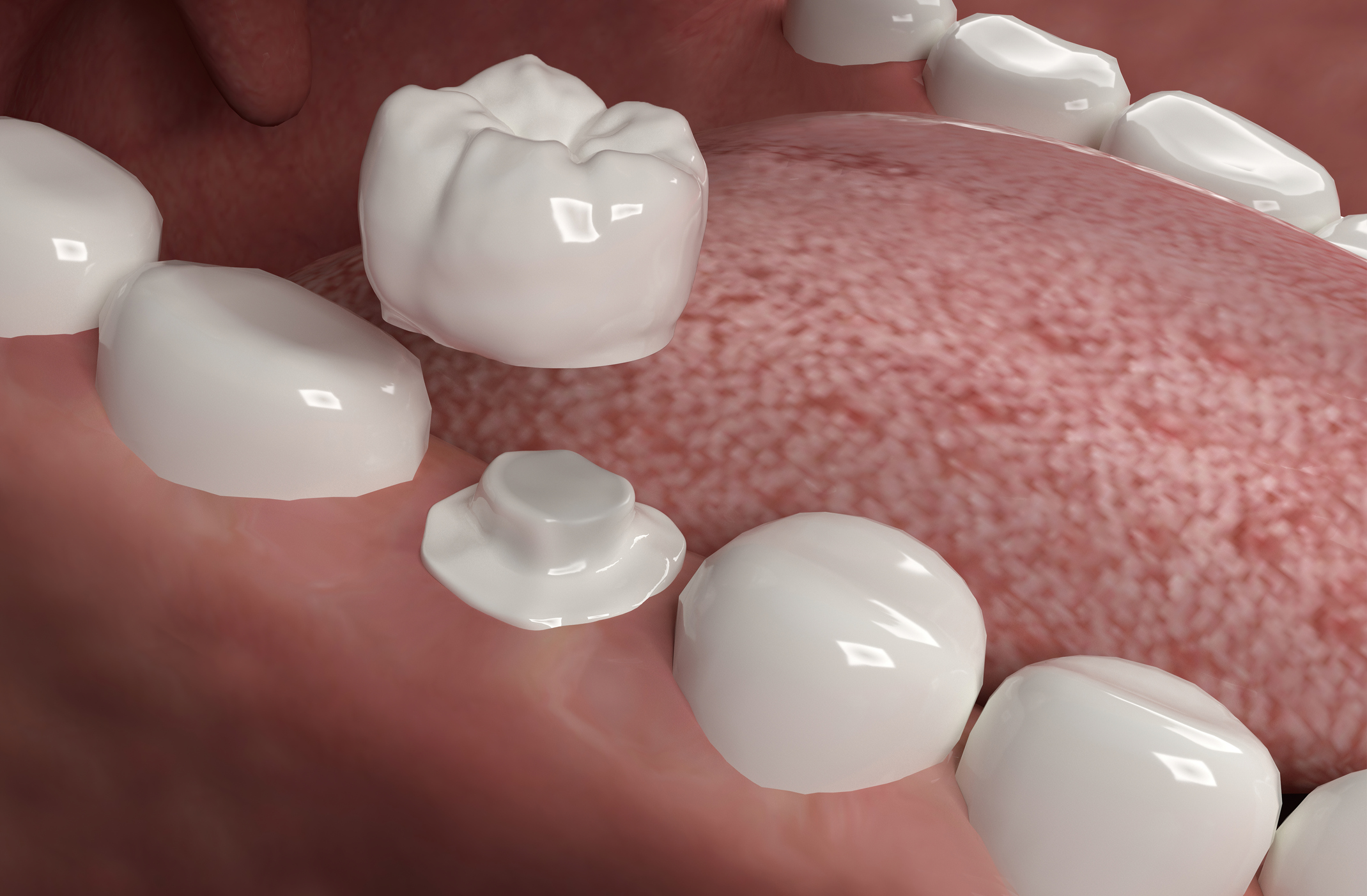 Porcelain, Teeth, Installing, Dental Veneers, Tooth Crown