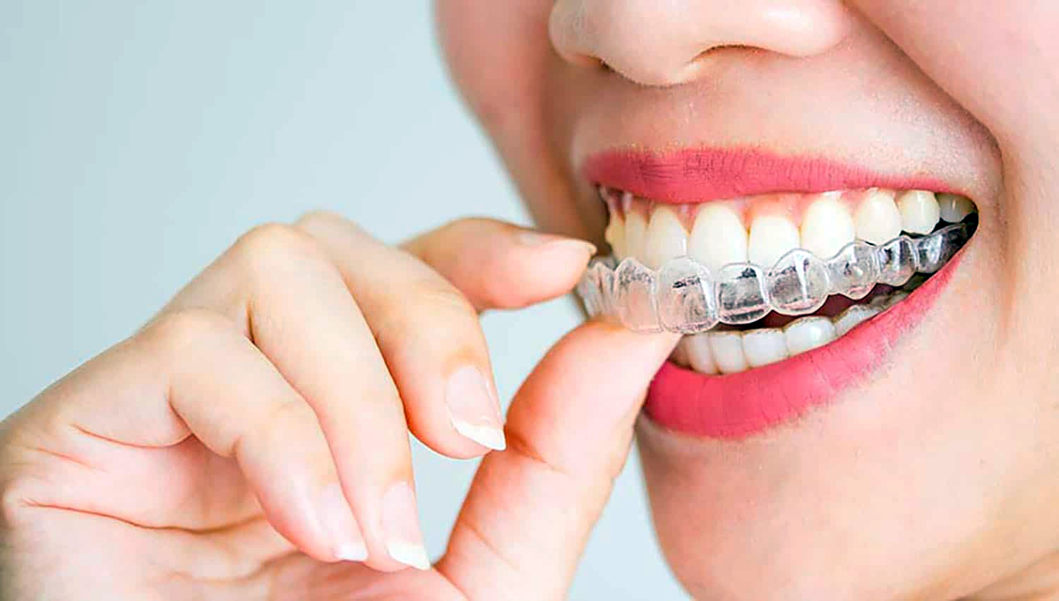 invisalign