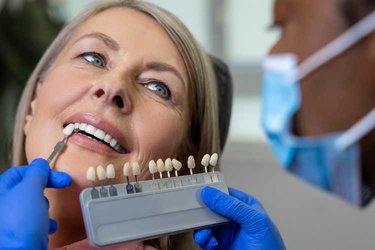 veneers-color-chart