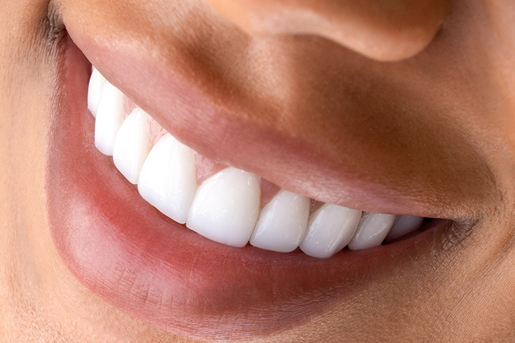 veneers-smile