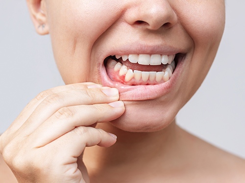 Woman pressing down her lip and revealing inflamed gums.